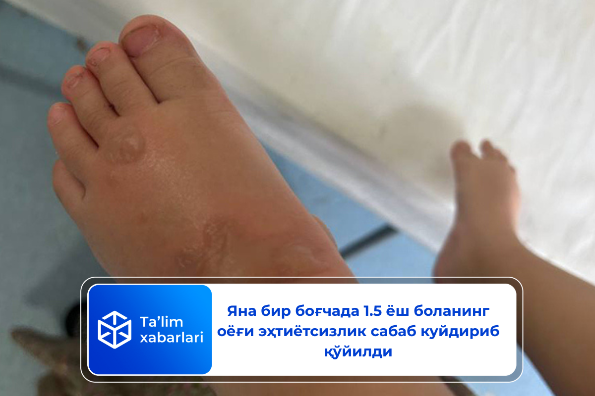 Яна бир боғчада 1.5 ёш боланинг оёғи эҳтиётсизлик сабаб куйдириб қўйилди