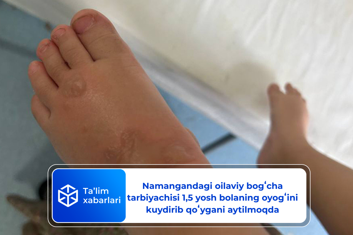 Namanganda oilaviy bogʻcha tarbiyachisi 1,5 yosh bolaning oyogʻini kuydirib qoʻygani aytilmoqda